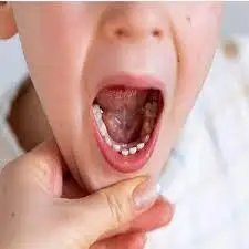 علاج التهاب اللثة حول الضرس للاطفال علاج التهاب اللثة حول الضرس للاطفال