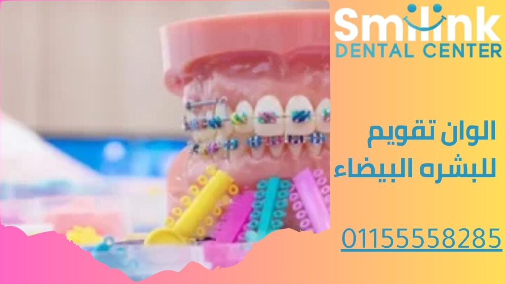 الوان تقويم الاسنان المتصل