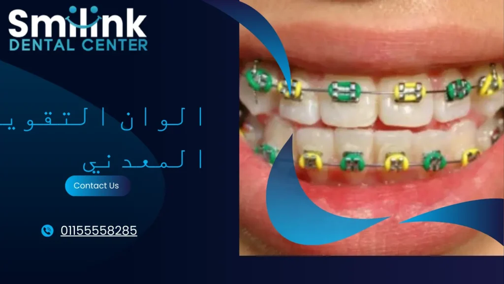 ألوان تقويم أسنان