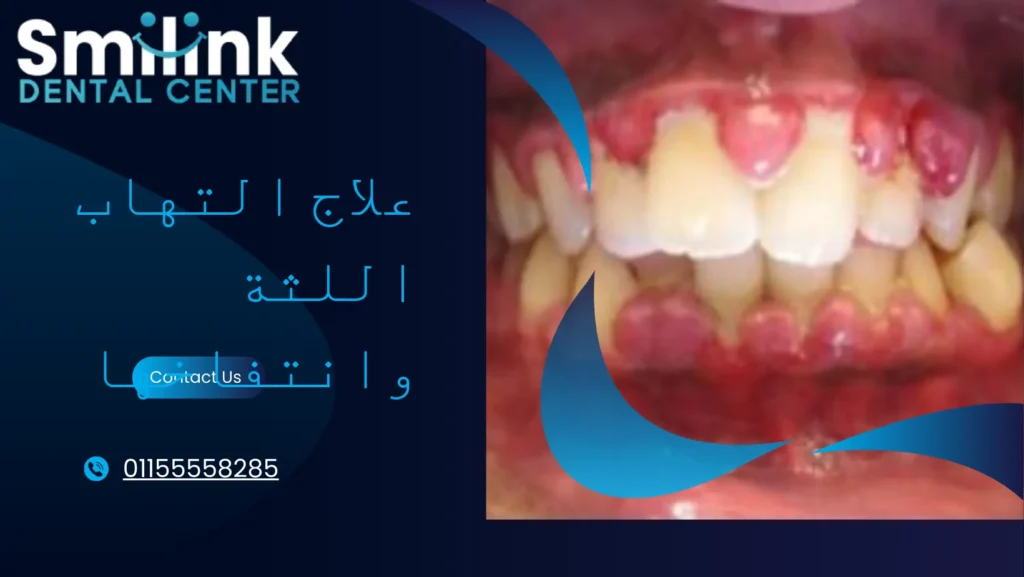 علاج نزيف اللثة بالمنزل علاج نزيف اللثة بالمنزل