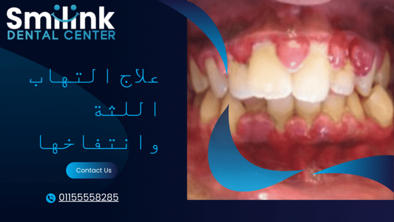 علاج التهاب الاسنان في البيت