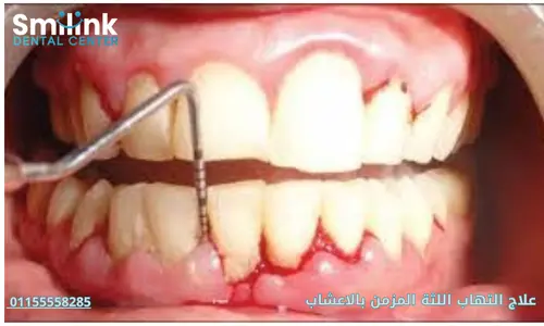 سمايل لينك | علاج التهاب اللثة المزمن بالاعشاب