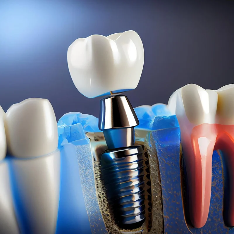 افضل دكتور زراعة اسنان في المحلة افضل دكتور زراعة اسنان في المحلة