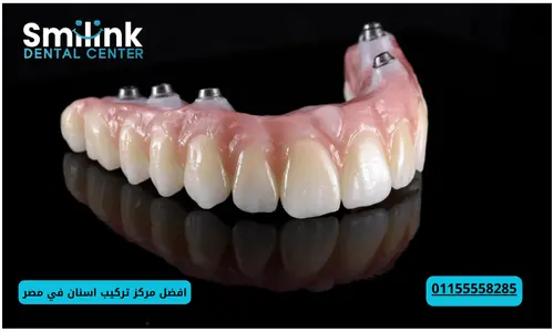 تركيب اسنان سيراميك تركيب اسنان سيراميك