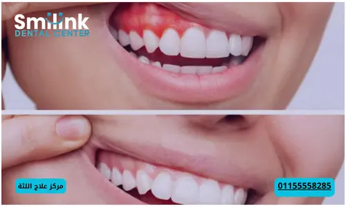 علاج مشاكل اللثة ونزيفها علاج مشاكل اللثة ونزيفها