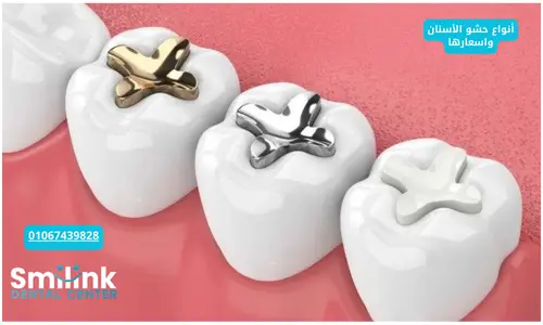 حشو الاسنان التجميلي حشو الاسنان التجميلي
