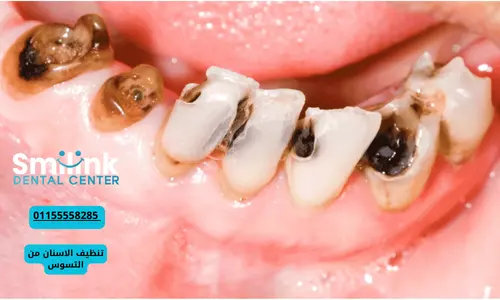 تنظيف الاسنان من التسوس