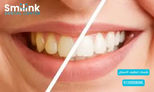 عمليات تجميل الاسنان قبل وبعد عمليات تجميل الاسنان قبل وبعد