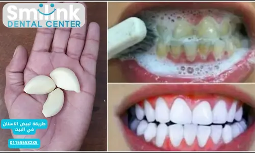 طريقة تبيض الاسنان في البيت
