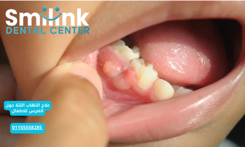 مشاكل اللثة: الأسباب، الأعراض، والعلاج الفعال 01155558285 مشاكل اللثة: الأسباب، الأعراض، والعلاج الفعال 01155558285