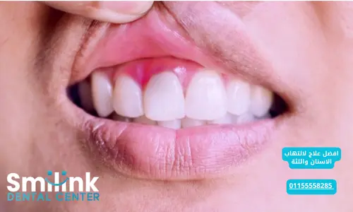 سمايل لينك | افضل علاج لالتهاب الاسنان واللثة
