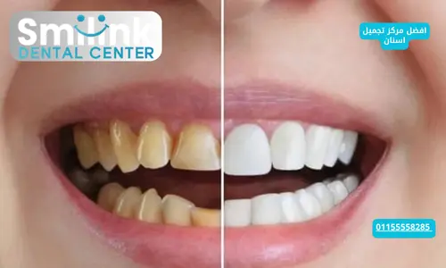 افضل مركز تجميل اسنان