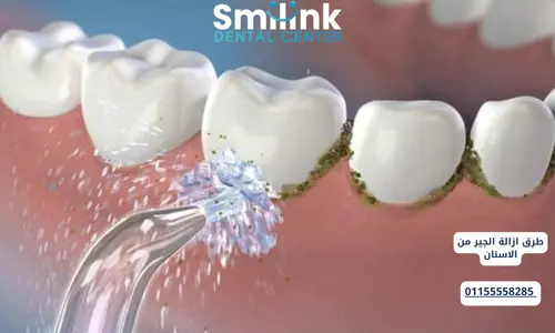 طرق ازالة الجير من الاسنان
