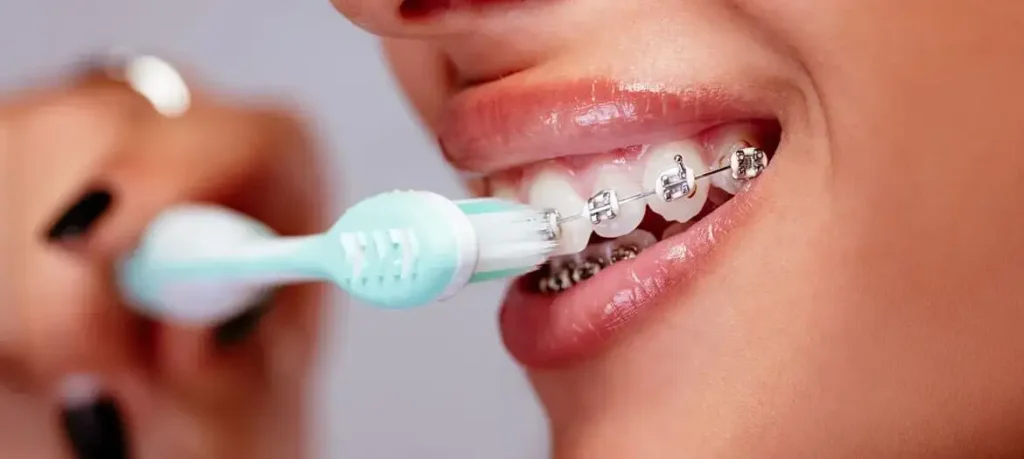 أنواع تقويم الأسنان 2025