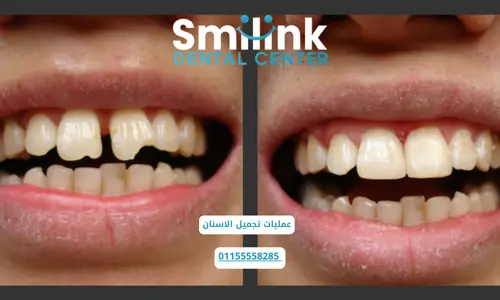 عمليات تجميل الاسنان