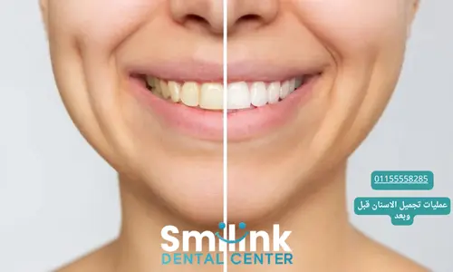 سمايل لينك | عمليات تجميل الاسنان قبل وبعد