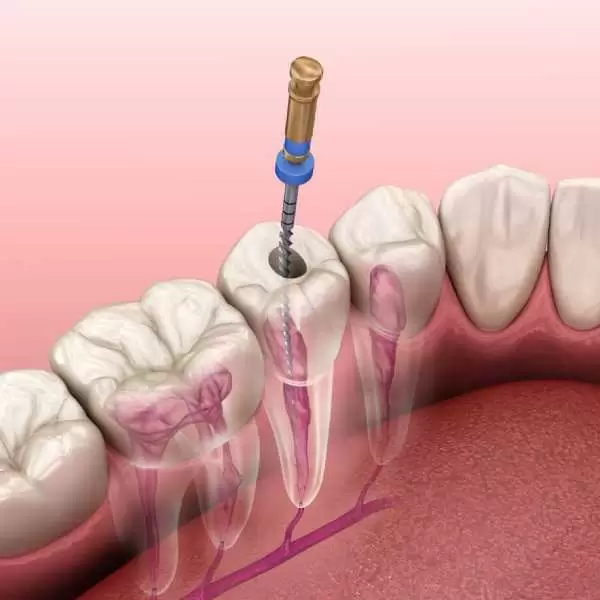 أحدث تقنيات علاج العصب بدون ألم أحدث تقنيات علاج العصب بدون ألم
