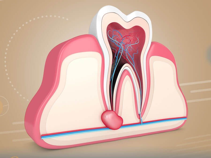 أحدث تقنيات علاج العصب بدون ألم أحدث تقنيات علاج العصب بدون ألم