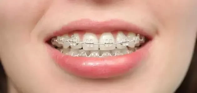 اشكال تقويم الاسنان وانواعه