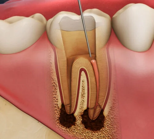أحدث تقنيات علاج العصب بدون ألم أحدث تقنيات علاج العصب بدون ألم