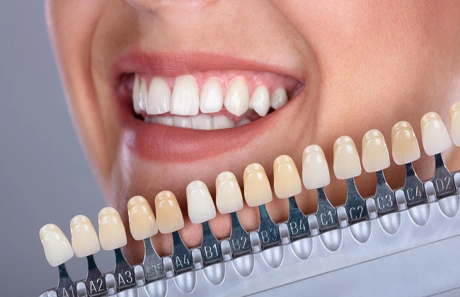 كيف تختار نوع تبييض الأسنان المناسب لك؟