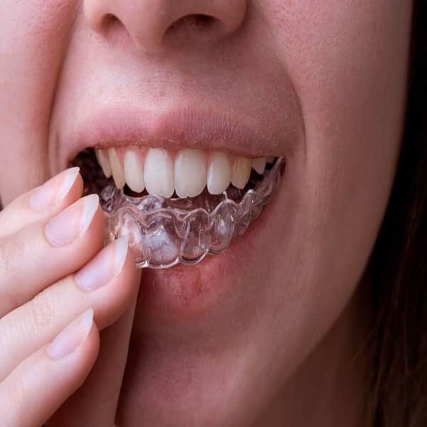تقويم الاسنان الشفاف الانفزلاين