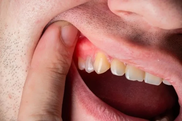 علاج مشاكل اللثة ونزيفها