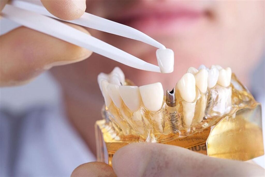 كيف تقلل مخاطر فشل زراعة الأسنان؟