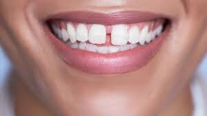 علاج فراغات الأسنان بدون تقويم علاج فراغات الأسنان بدون تقويم