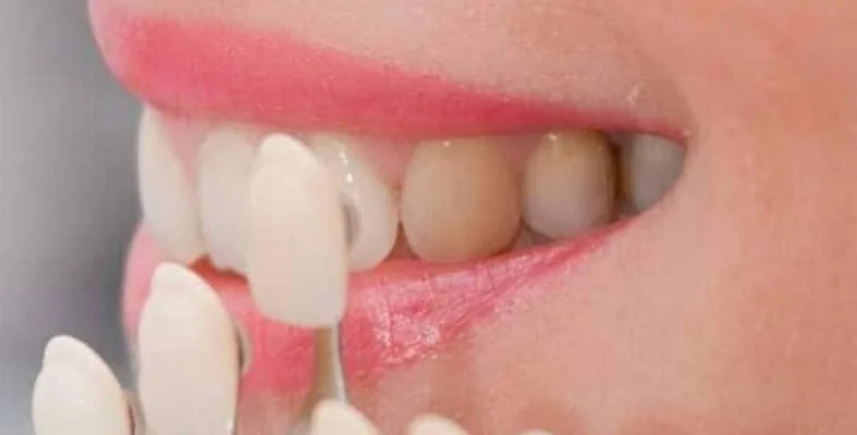تركيب عدسات الأسنان (الفينير واللومينير)01155558285 5 تركيب عدسات الأسنان (الفينير واللومينير)