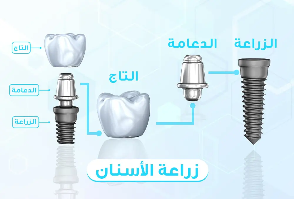 زراعة الأسنان الفورية في يوم واحد