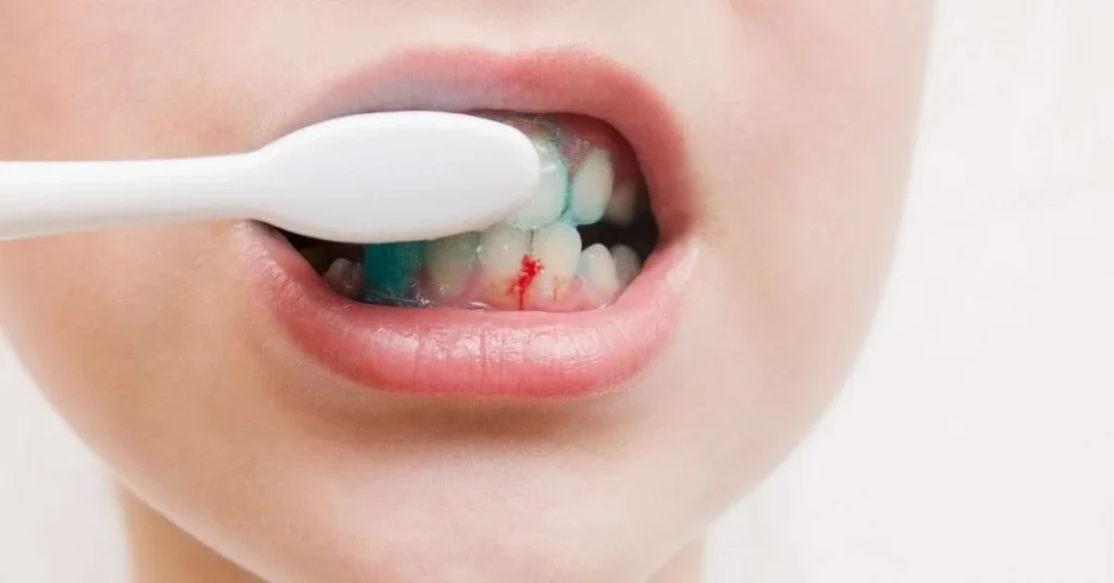 علاج مشاكل اللثة ونزيفها