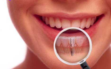 نصائح العناية اليومية بعد زراعة أو تجميل الأسنان 01155558285&nbsp;