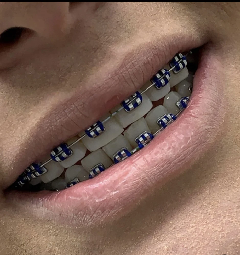 ألوان تقويم أسنان للرجال