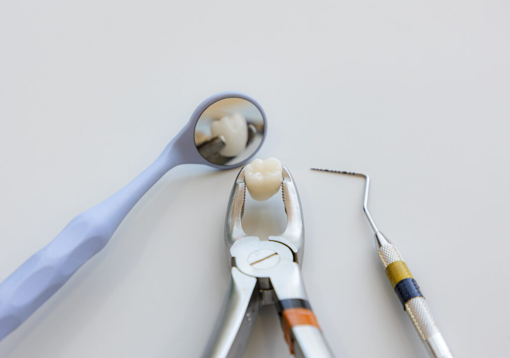 خلع الأسنان الجراحي خلع الأسنان الجراحي