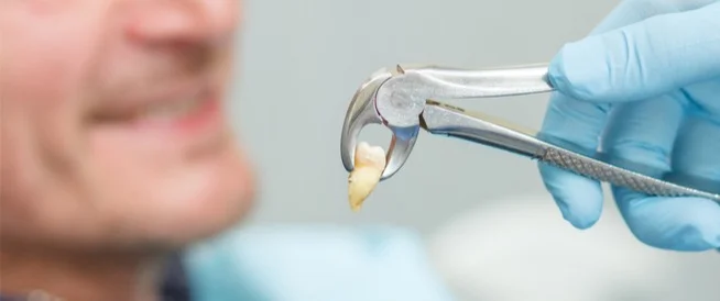 خلع الأسنان الجراحي خلع الأسنان الجراحي