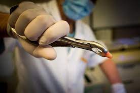 خلع الأسنان الجراحي خلع الأسنان الجراحي