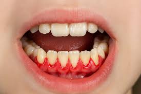 علاج التهابات اللثه والاسنان