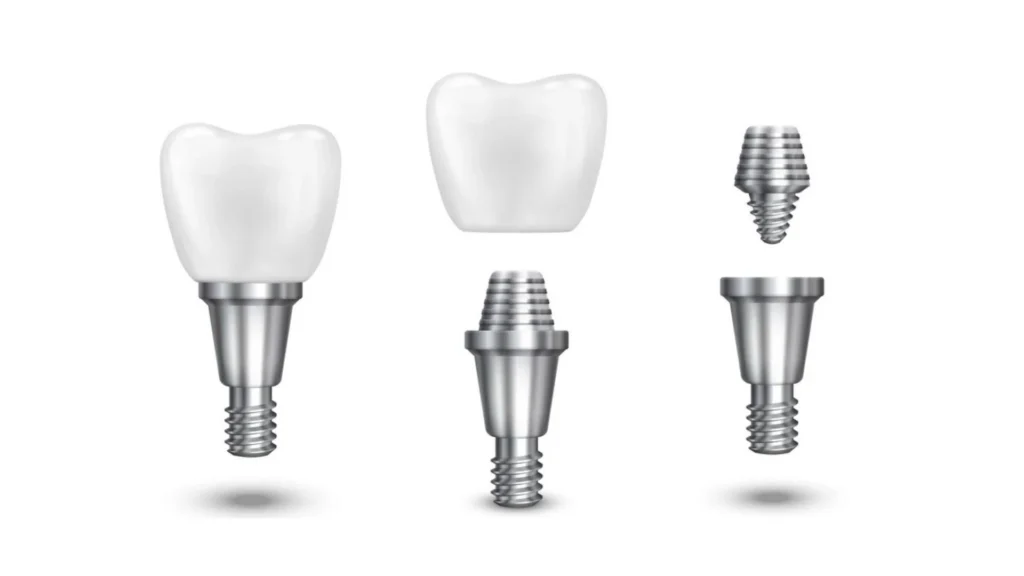 كيف تختار أفضل مركز لزراعة الأسنان في المهندسين؟01155558285