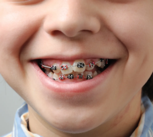 خدمات طب الأسنان للأطفال خدمات طب الأسنان للأطفال