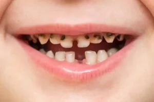 علاج كسر الأسنان علاج كسر الأسنان