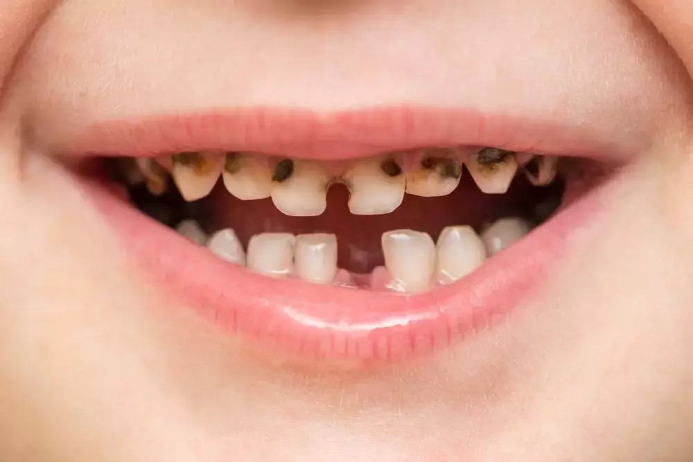 ما هو تسوس الأسنان؟ الأسباب، الأعراض وطرق الوقاية 01155558285