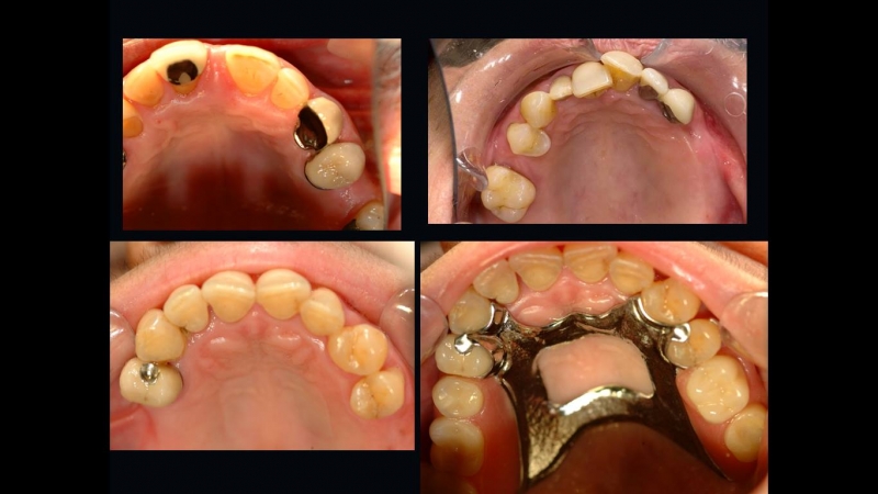سمايل لينك | الترميمات السنية التجميلية سمايل لينك | الترميمات السنية التجميلية