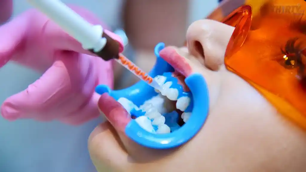 سمايل لينك | كل ما تريد معرفته عن تبييض الأسنان: الأنواع، النتائج ومدة التأثير 01155558285