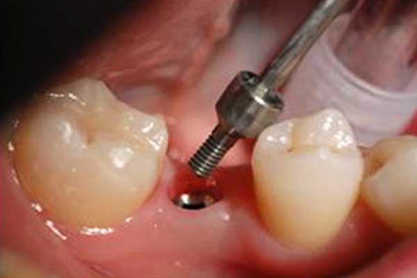 سمايل لينك | كيف تقلل مخاطر فشل زراعة الأسنان؟ سمايل لينك | كيف تقلل مخاطر فشل زراعة الأسنان؟