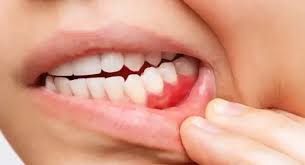 مشاكل اللثة