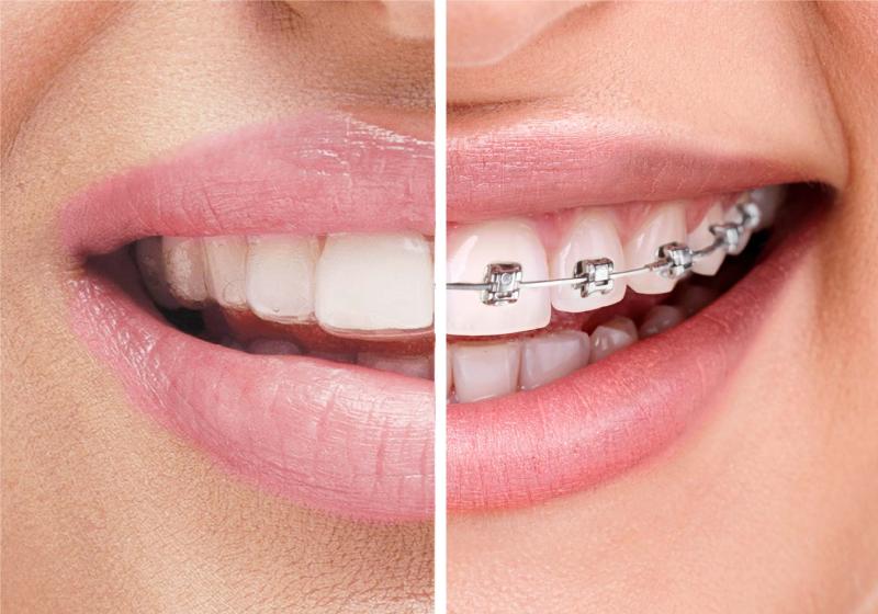 تقويم الأسنان: الفرق بين التقليدي والشفاف (Invisalign)