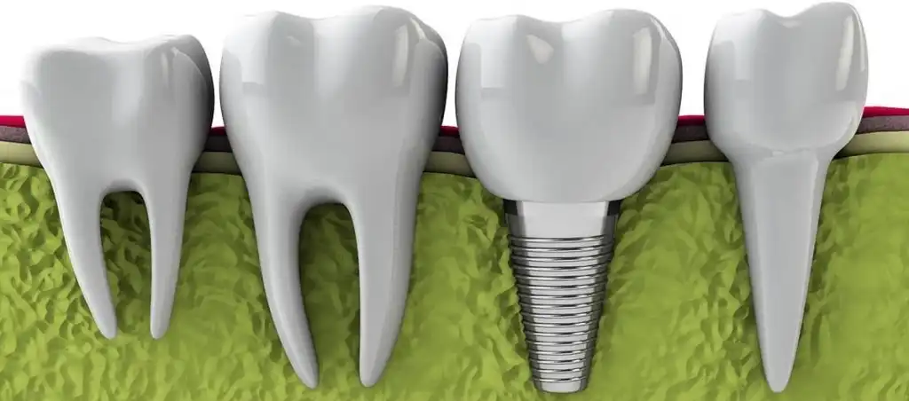 زراعة الأسنان في المهندسين