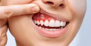 التهاب اللثة المزمن: أعراضه ومضاعفاته