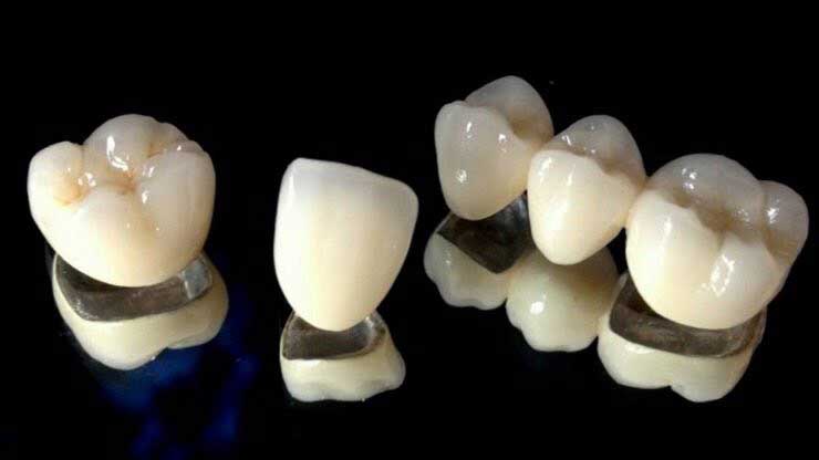 تركيبات الأسنان للضروس الخلفية